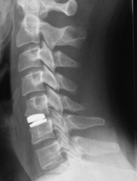 Figura 16.- RX lateral de columna cervical. Control radiológico tras colocar una prótesis de disco artificial