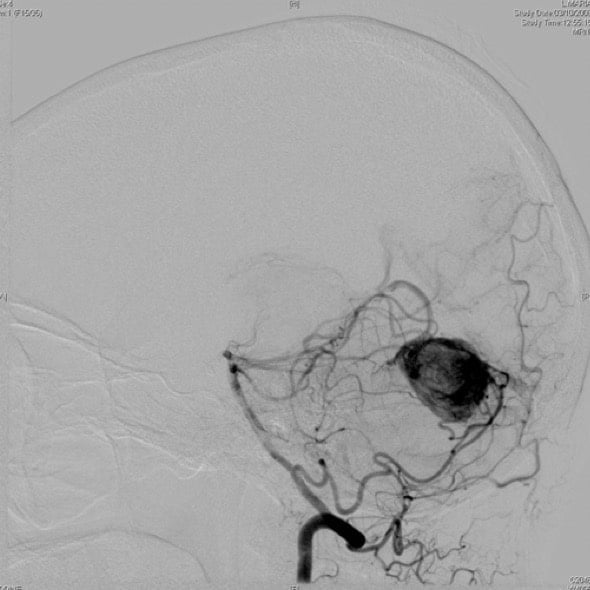 Figura 17.- Angiografia cerebral. Se observa la intensa vascularización de la lesión nodular.