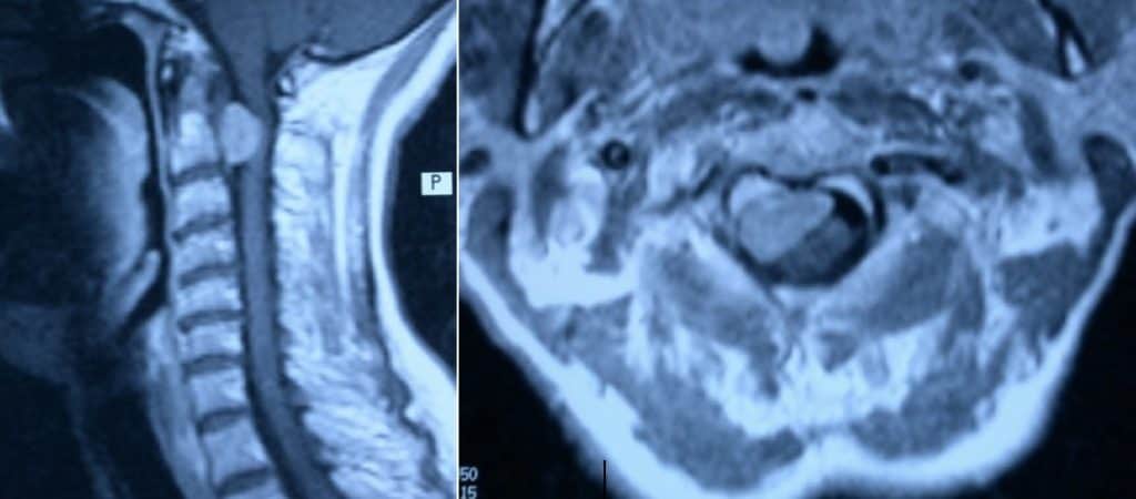 Figura 17.- RM meningioma a nivel C2, implantado en la cara anterior derecha del canal vertebral