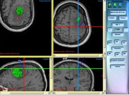Figura  18.- Neuronavegador para la localización y resección de un tumor cercano a áreas motoras