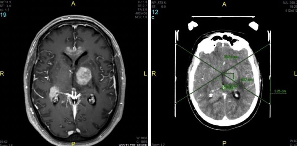 Figura 18.- RM craneal de linfoma multicéntrico y TAC con guía estereotáxica, para cálculo de coordenadas y biopsia.
