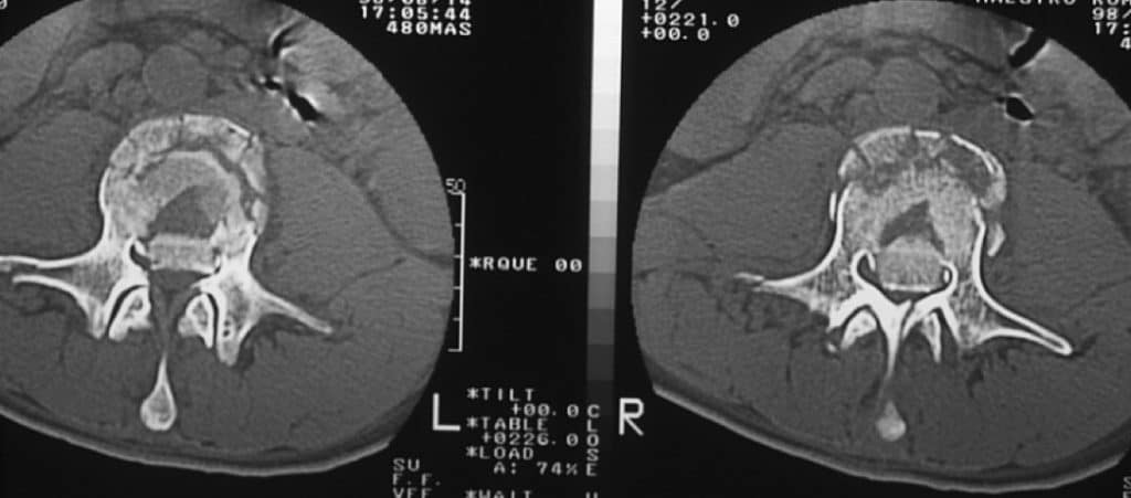 Figura 18.- TAC lumbar. Fractura-estallido del cuerpo vertebral con invasión del canal
