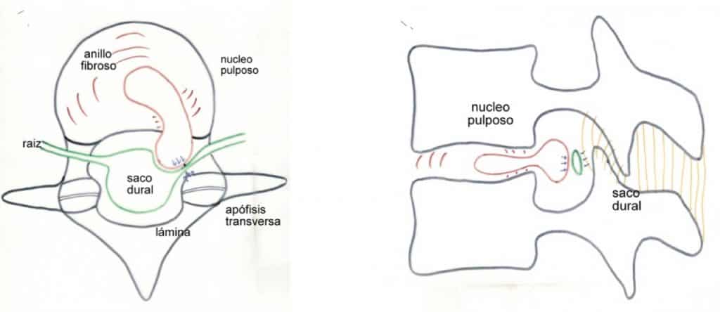 Figura 19.- Esquema de la disposición de una hernia discal lumbar, comprimiendo la raíz