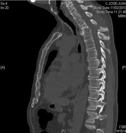 Figura 19.- Fractura vertebral (hundimiento) por invasión metastásica vertebral. Se puede apreciar que no se afectan los discos intervertebrales