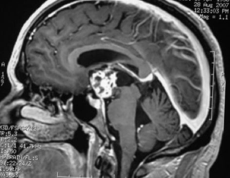 Figura 19.- RM sagital de craneofaringioma con extensión supraselar.