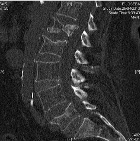 Figura 19.- TAC con fracturas múltiples pos osteoporosis