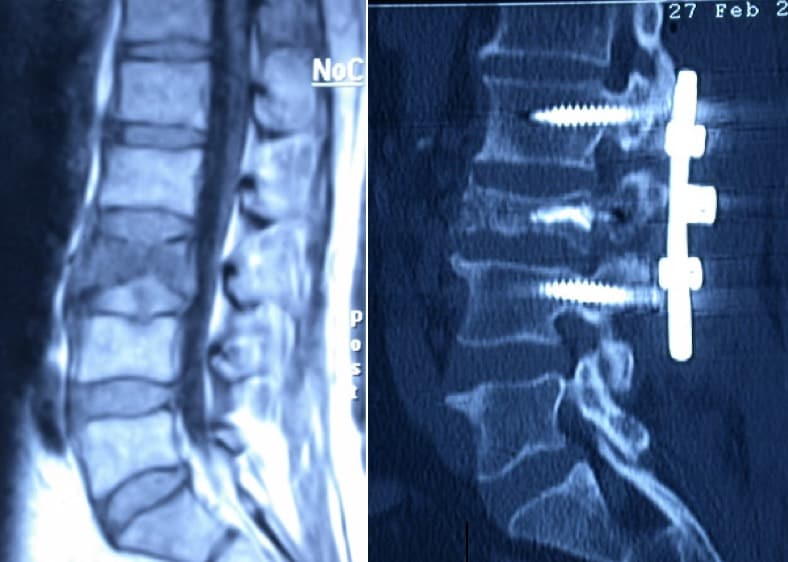 Figura 20.- Metástasis vertebral en L3. Biopsia y vertebroplastia, junto con fijación pedicular