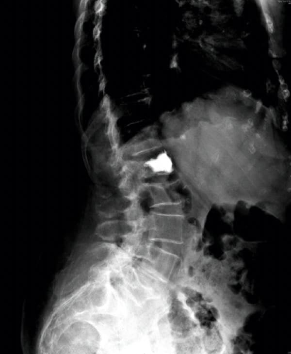 Figura 20.- Control Rx tras inyección de cemento acrílico (vertebroplastia)