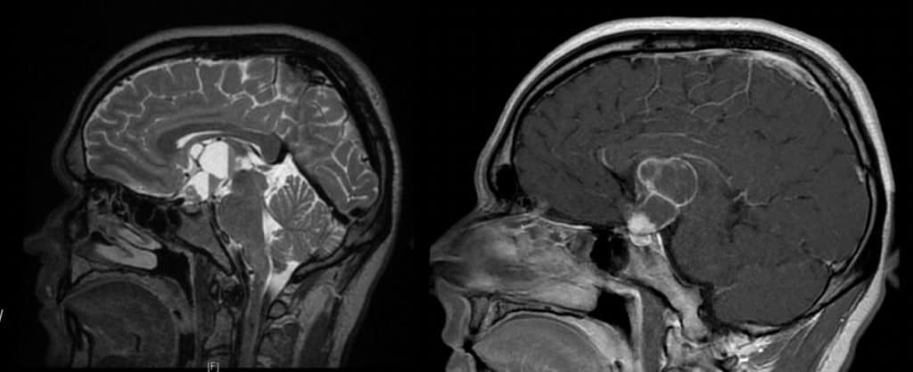 Figura 20.- RM sagital T1 y T2 de craneofaringioma con gran componette quístico dentro del III ventrículo.