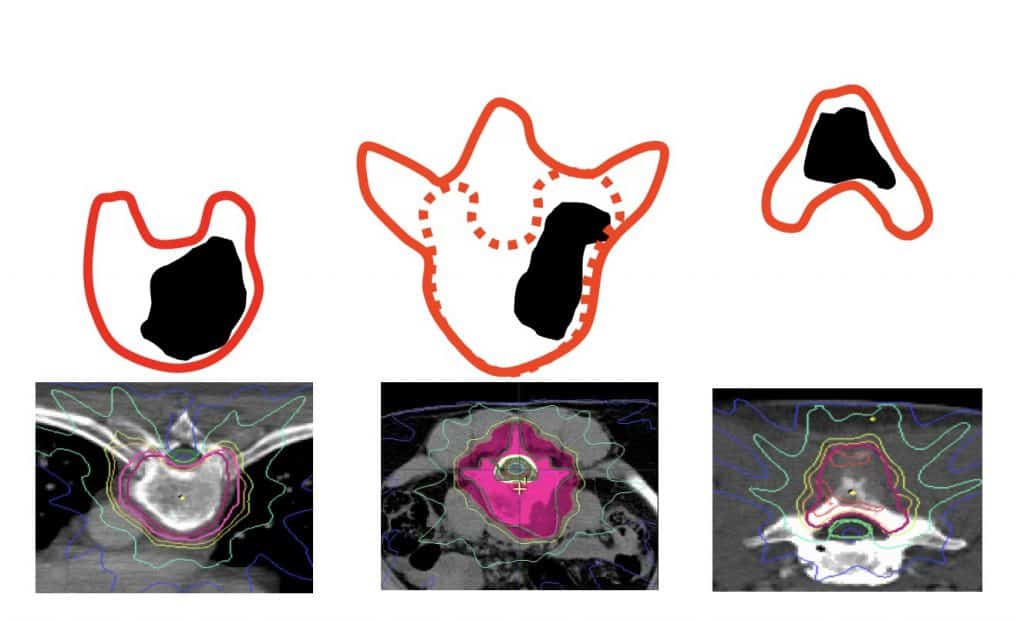 Figura 21.- Esquemas de tratamiento con radioterapia estereotáxica fraccionada (Ryu et al. Cancer 2007)