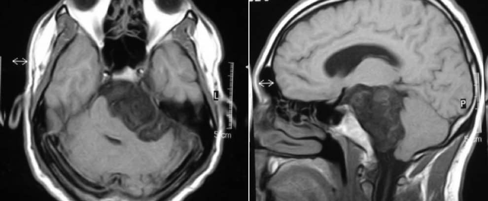 Figura 21.- RM axial y sagital. Se observa lesión hipointensa a nivel del ángulo pontocerebeloso izquierdo. Tumor epidermoide.