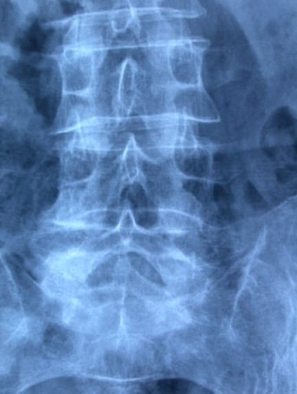 Figura 21.- RX de columna. Escoliosis antiálgica