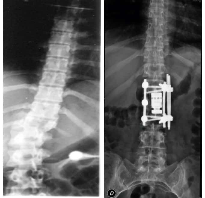 Figura 21.- Rx de columna de una fractura-luxación lateral de D12-L1, tras realizar una artrodesis combinada anterior y posterior