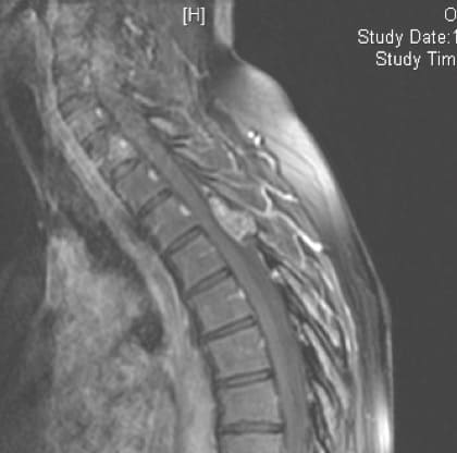 Figura 22.- RM cervical. Quiste óseo aneurismático que afecta al arco posterior de C7