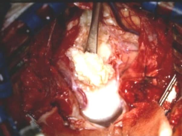 Figura 22.- Imagen quirúrgica de un tumor epidermoide.