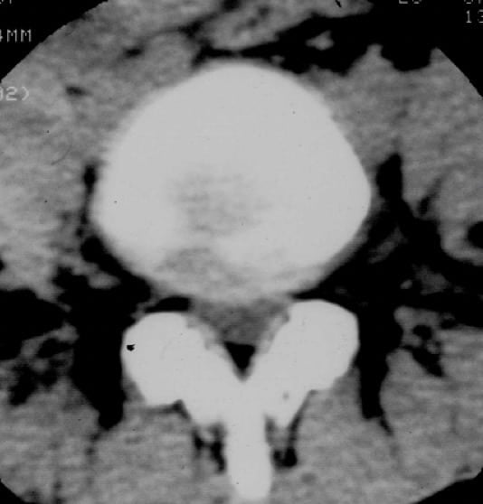 Figura 22.- TAC de columna. Se observa hernia central