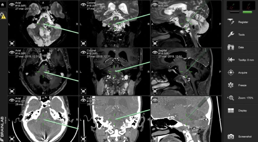 Figura  23.- Imágenes intraoperatorias (Neuronavegador) de un Tumor Dermoide a nivel de ángulo pontocerebeloso izquierdo y clivus.