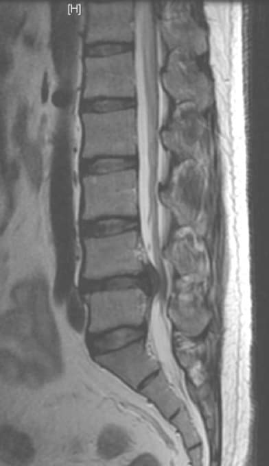 Figura 23.- RM de columna lumbar. Se observa el disco herniado