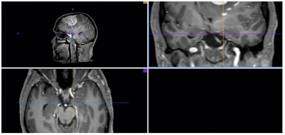 Figura 4.- RM de un meningioma gigante de convexidad izquierda. Se aprecia el inicio de la incarceración del uncus temporal derecho en el orificio del tentorio. 