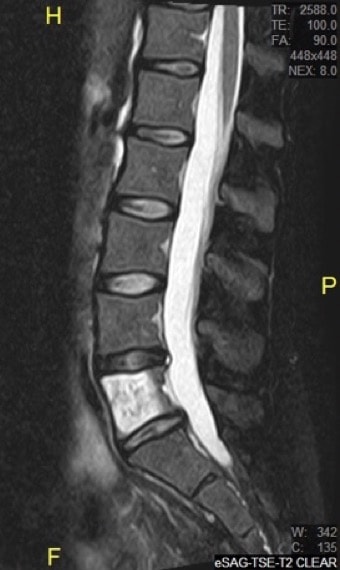 Figura 23.- RM sagital de hemangioma de L5