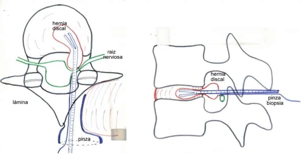 Figura 24.- Esquema de la intervención quirúrgica, microdiscectomía, para extirpar el disco intervertebral