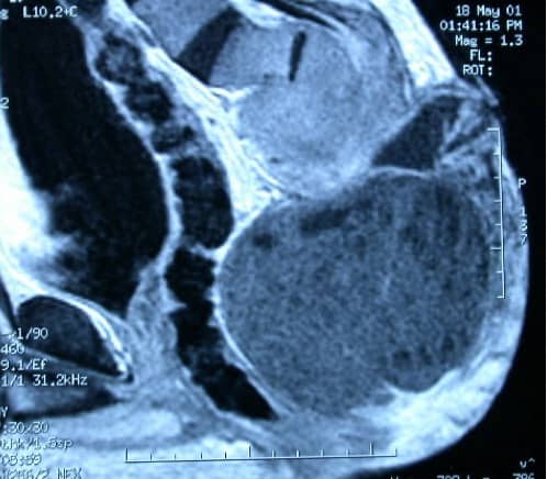 Figura 25.- RM lumbosacra con gran masa a nivel de sacro, con afectación ósea e intracanal. Cordoma sacro