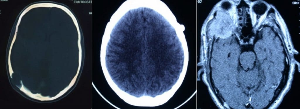 Figura 25.- Tumores a nivel de calota: Epidermoide, Osteoma; y Plasmocitoma a nivel de orbita derecha.