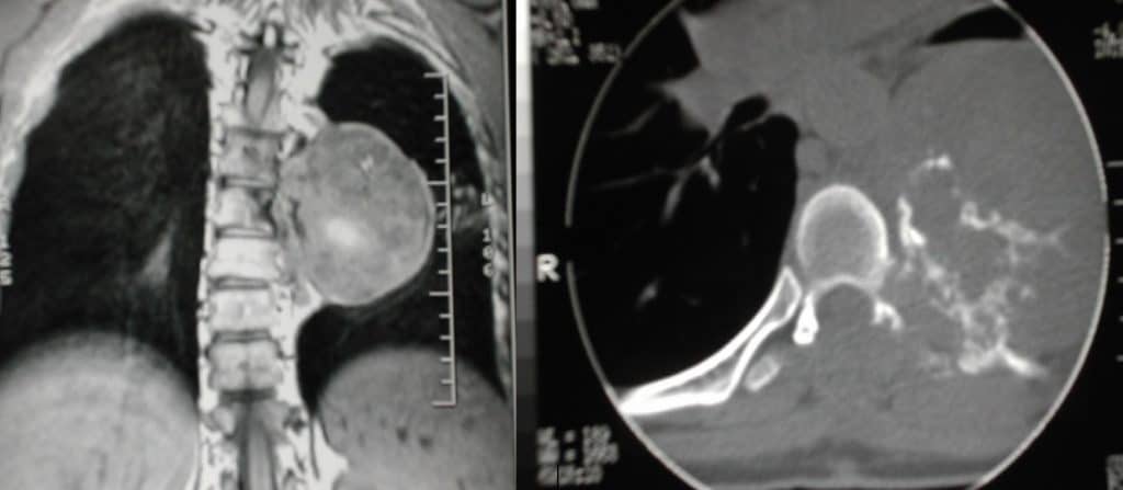 Figura 26.- Condrosarcoma