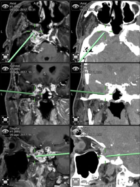 Figura 26.- Imágenes de Neuronavegador, RM y TAC axial, sagital  y coronal de lesión  en el clivus. Cordoma.