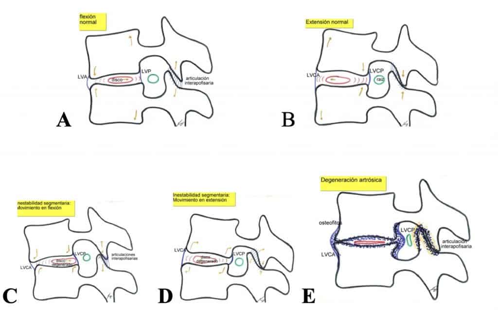 Figura 26.- Secuencia de la degeneración espondilótica. A y B: Movimientos normales, de flexión-extensión, con congruencia entre las articulaciones interapofisarias e intersomática. C y D: Comienza la degeneración discal y la incongruencia entre las articulaciones. E: El resultado es la aparición de fenómenos artrósicos de las articulaciones e hipertrofia de ligamentos