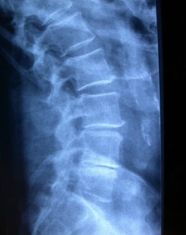 Figura 27.- Columna lumbar, con colapsos discales e inicio de estenosis lumbar