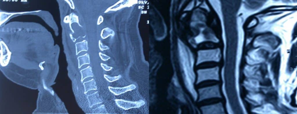 Figura 27.- RM cervical con plasmocitoma a nivel de C2