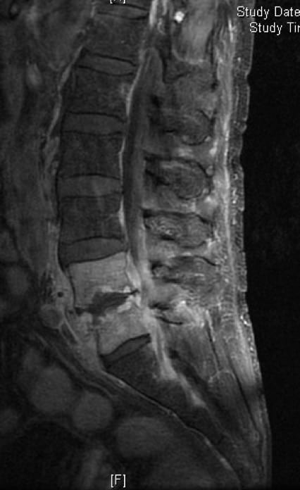 Figura 28.- Discitis lumbar. Afectación del disco, cuerpos vertebrales y colección epidural