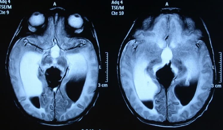 Figura 5.- RM axial. Se observa hidrocefalia por hemorragia intraventricular
