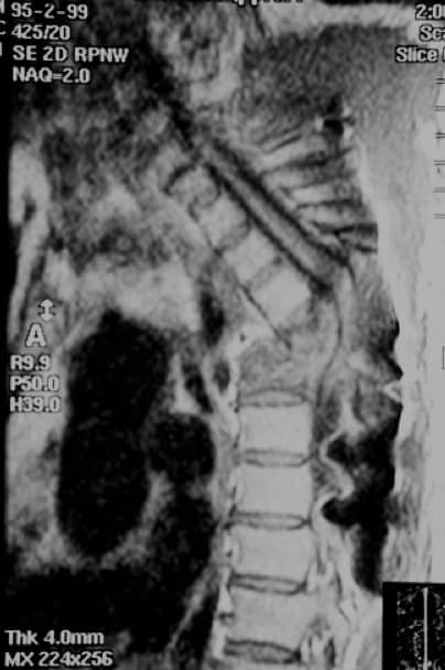 Figura 29.- RM dorsal en paciente con tuberculosis vertebral. Destrucción vertebral completa con sección medular