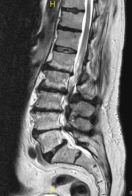 Figura 29.- RM lumbar con estenosis de canal en varios niveles