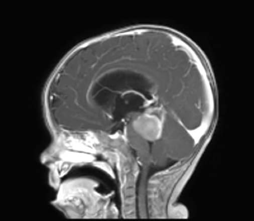 Figura  6.- Hidrocefalia por obstrucción del IV ventrículo por un Meduloblastoma.