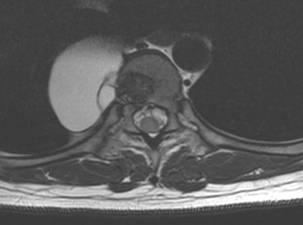 Figura 30.- RM axial con quiste hidatídico paravertebral derecho