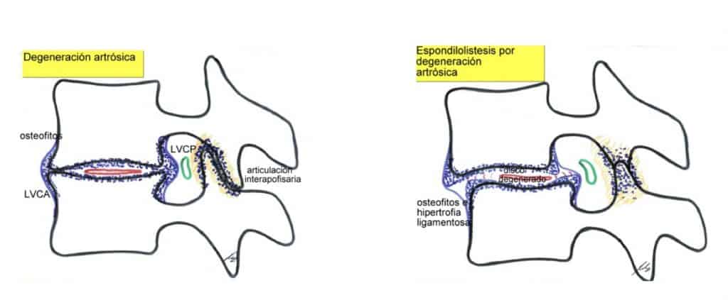 Figura 31.- Proceso de degeneración, que puede desembocar en una espondilolistesis