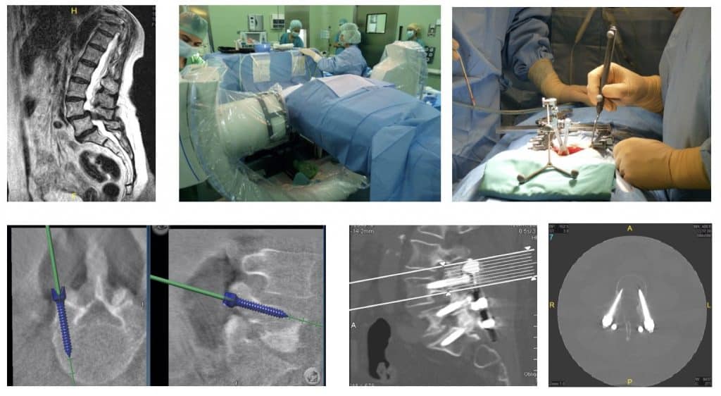 Figura 33.- Espondilolistesis L4-L5. Imagebn de quirófano, con la colocación dekl paciente y el equipo de Rx que es capaz de realizar un TAC intraoperatorio. Arriba a la derecha, el sistema de detección del neuronavegador. Abajo, la simimulación de la colocación de los tiornillos pediculares. A la derecha, los controles de la colocación final de los tornillos