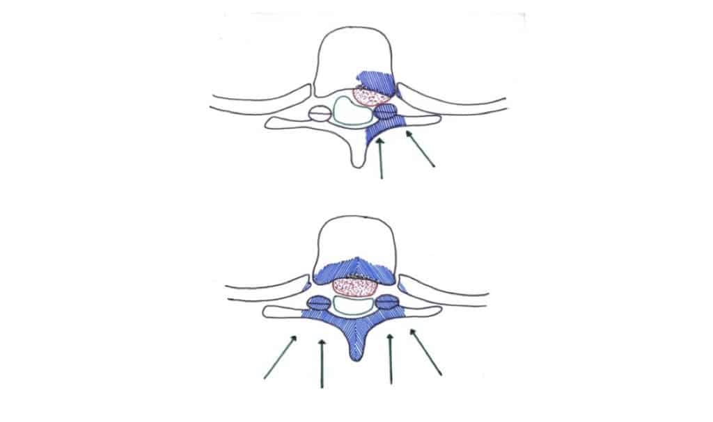 Figura 34.- Esquema del abordaje transfacetario propuesto por Stillerman. Uni o bilateral (si la hernia es muy central)