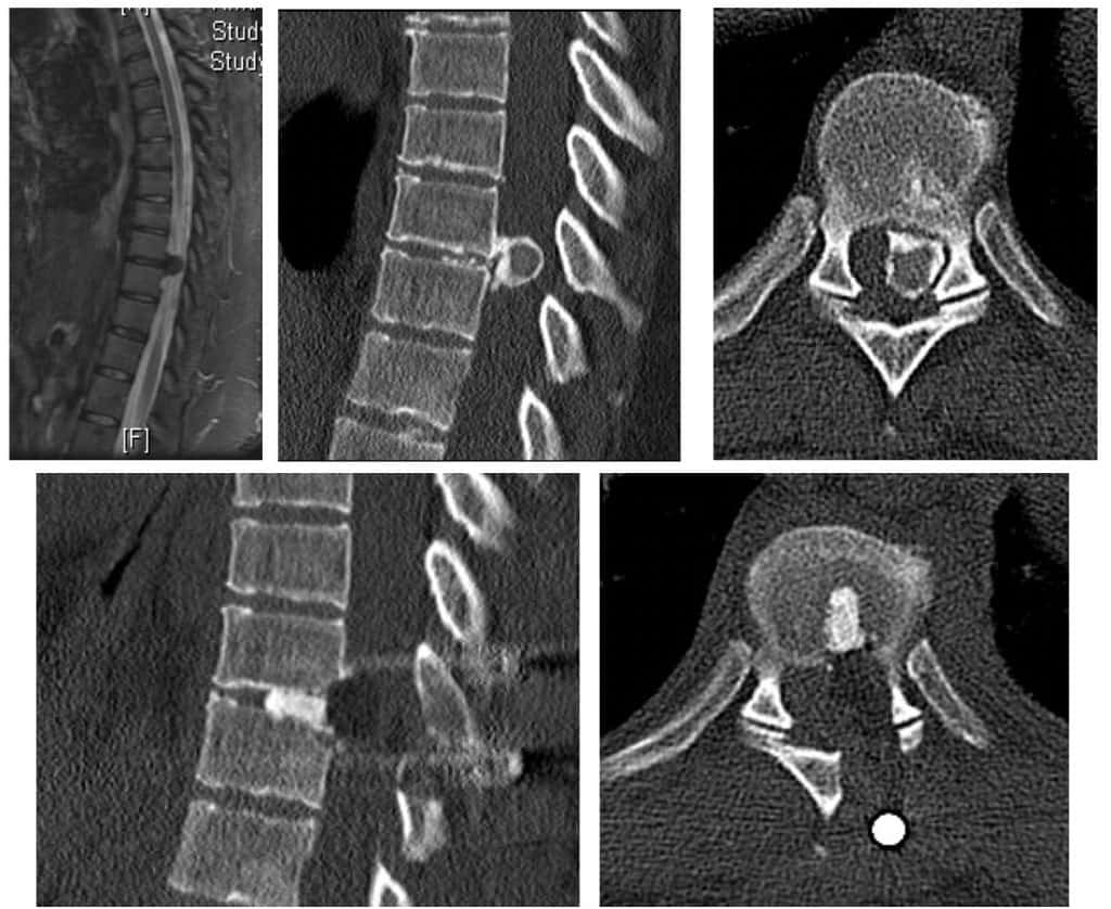 Figura 36.- Imágenes preoperatorias de una hernia dioscal torácica calcificada (arriba) y controles postquirúrgicos tras su extirpación y colocación de injerto oseo intersomático, para dar estabilidad al segmento