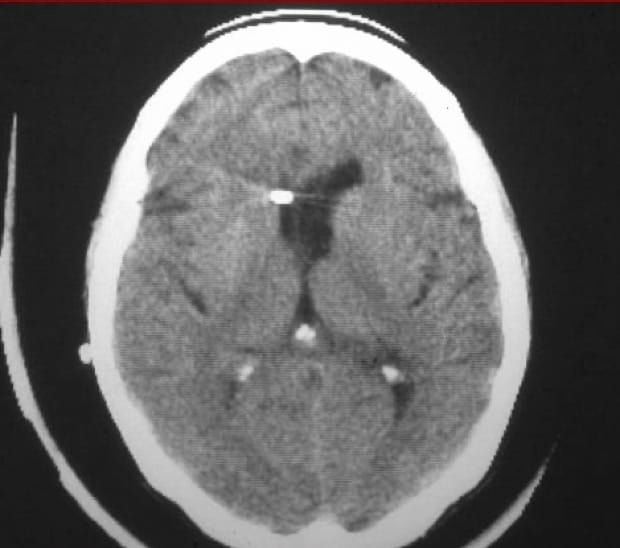 Figura 15.- TAC craneal de control tras colocar un sistema de derivación. Se observan los ventrículos colapsados y la punta del cateter en el ventrículo lateral derecho