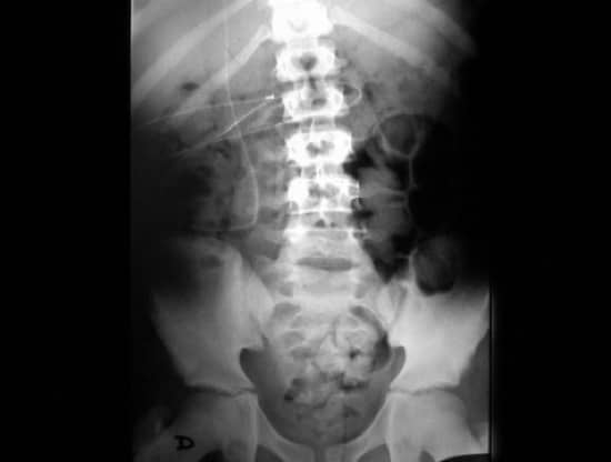 Figura 16.- Rx de abdomen donde se observa el catéter distal del sistema de derivación colocado en abdomen.
