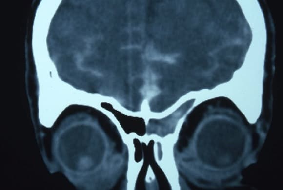 Figura 20.- TAC con Metrizamida, coronal de paciente con fístula de LCR postraumática a nivel de lámina cribosa. Se observa paso de contraste al seno frontal.