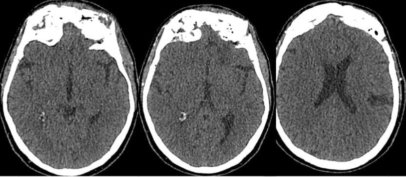 Fig. 4: Cortes axial de TC: Cambios postquirúrgicos en ambos senos frontales