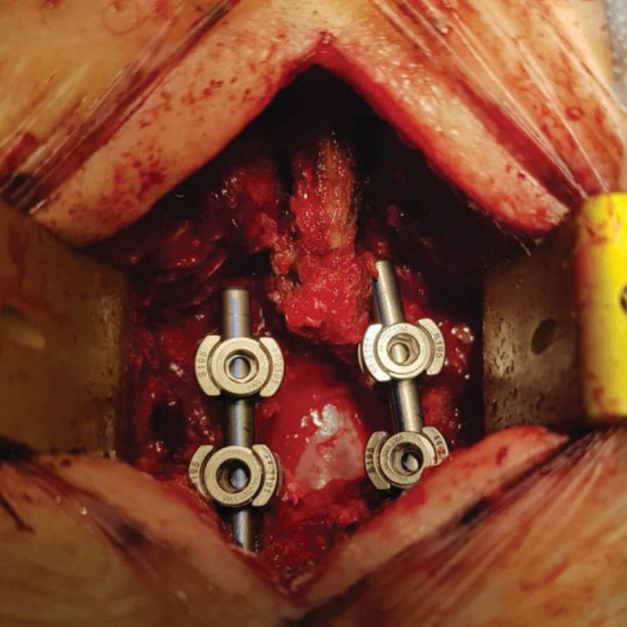 Trabajo del doctor Juan Delgado sobre simulaciñon 3d en la colocación de tornillos para la fijación de la columna vertebral