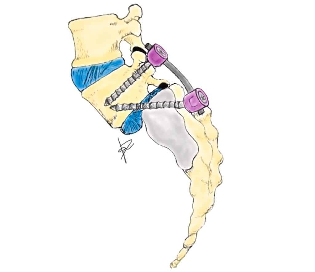 Fig. 1. Diagram of transdiscal or "delta" fiXation.