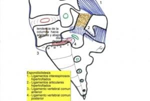 espodilolisteis garcia de sola
