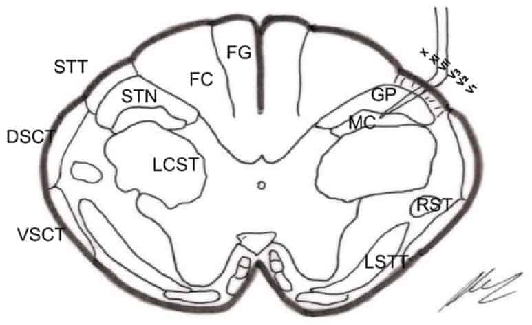Trigeminal nucleotomy